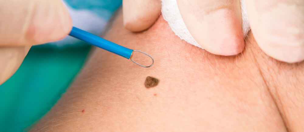 Extracting mole