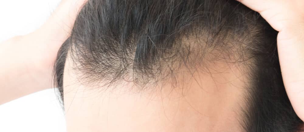 Androgenetic alopecia